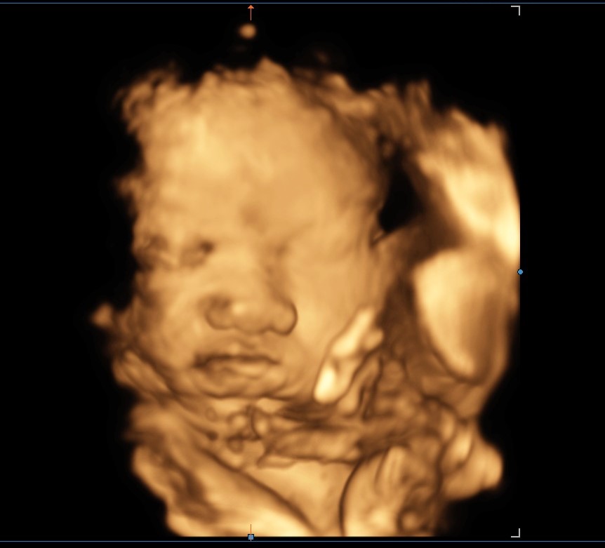 Standard ultrasound image